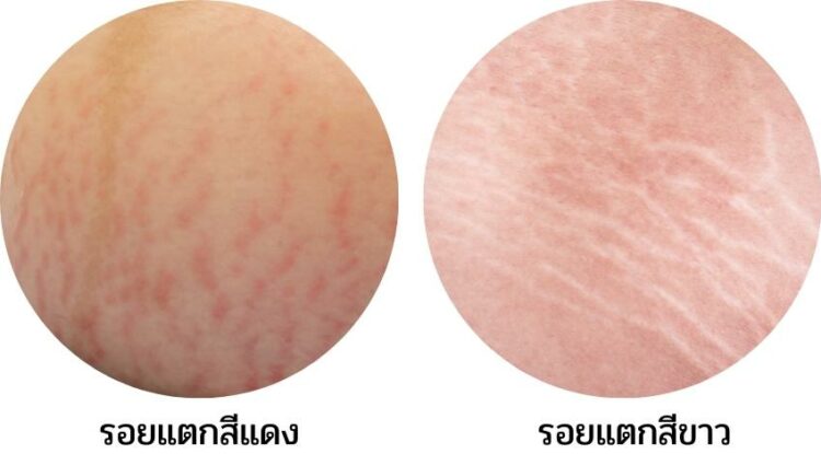 รอยแผลเป็นหรือรอยแตกลายให้ใช้ออยล์บำรุงผิวที่มีกรด Palmitoleic