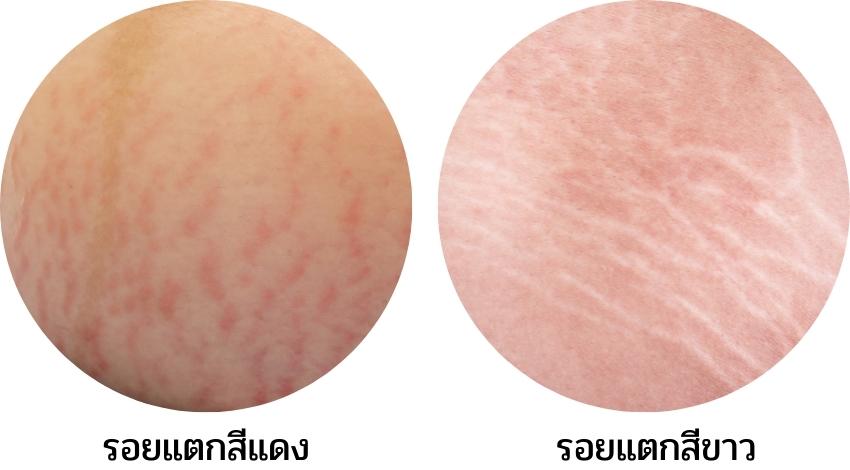รอยแตกลายสีแดงและสีขาว