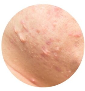 แผลเป็นจากสิว (Acne scars)