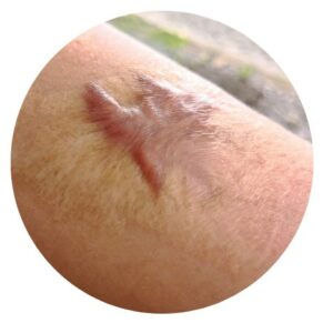 แผลเป็นคีลอยด์ (Keloid)