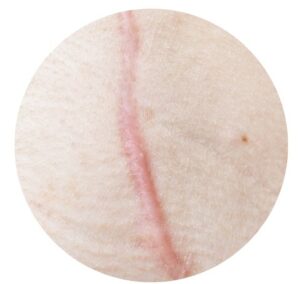 แผลเป็นที่มีการหดรั้ง (Contracture)