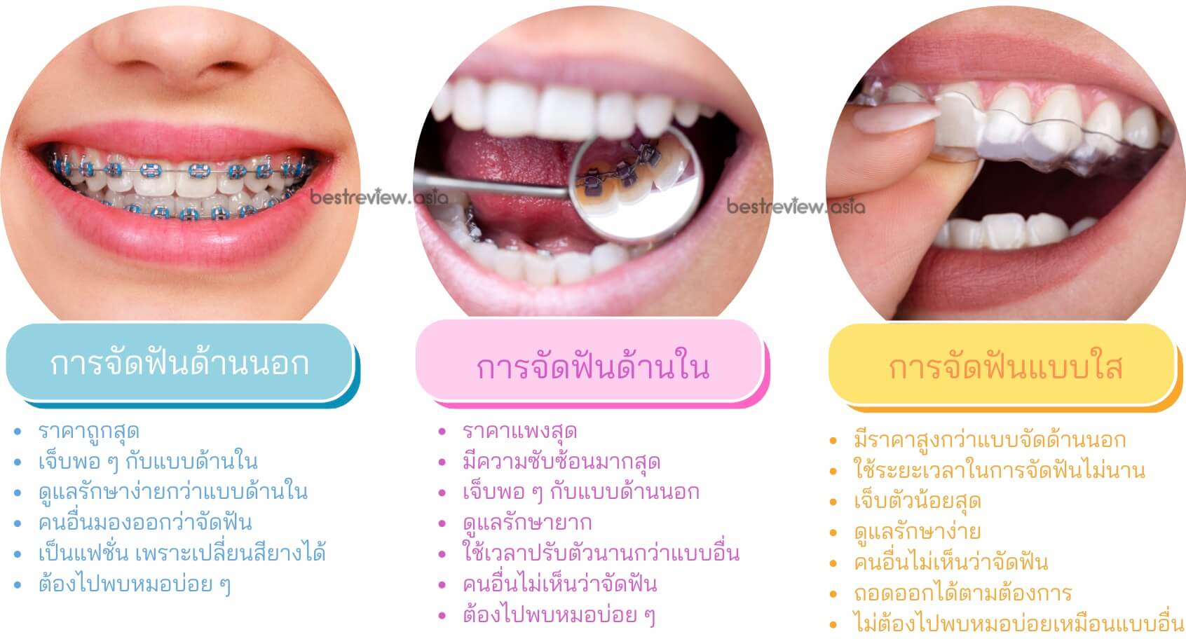 ประเภทของการจัดฟัน แบบไหนเหมาะกับคุณที่สุด