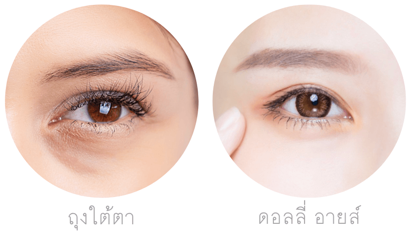 ถุงใต้ตา vs ดอลลี่ อายส์