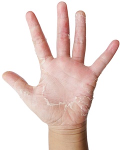 มือแห้ง มือลอก แพ้สารเคมี