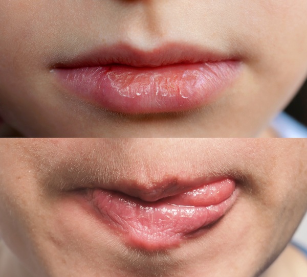ริมฝีปากเย็นสดชื่น แต่สามารถนำไปสู่ความแห้งกร้านได้