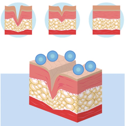 hyaluronic acid กรดไฮยาลูโรนิค ไฮยาลูรอน