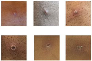 monkeypox โรคฝีดาษลิง
