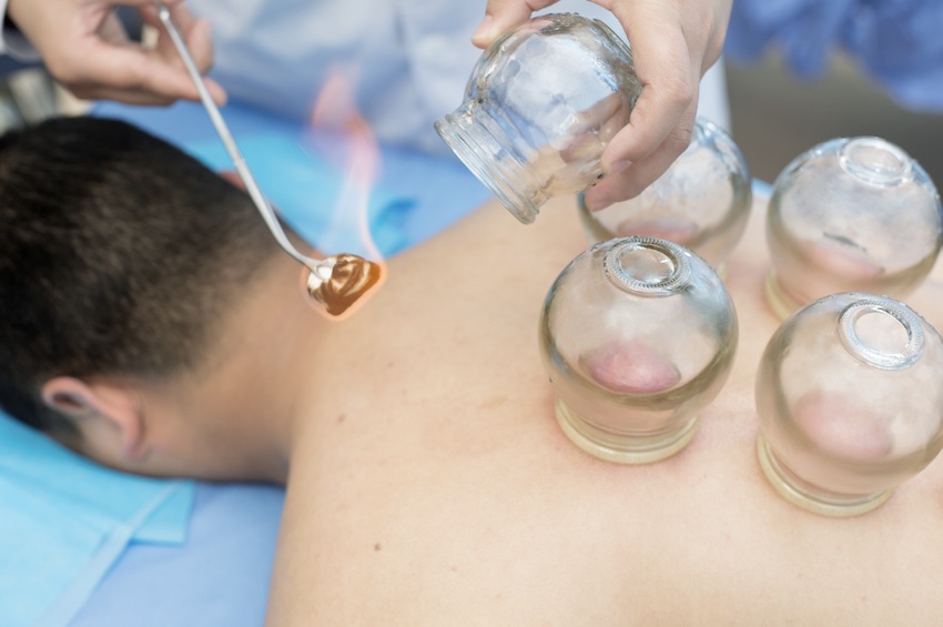 การครอบแก้ว (Cupping Therapy) ใช้ทฤษฎีการดูดผิวหนังหรือการทำให้เกิดสุญญากาศภายในแก้ว