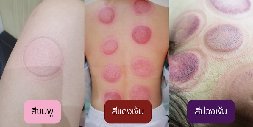 การครอบแก้วจะให้ผลลัพธ์รอยแดงบนผิวหนังของแต่ละคนที่ต่างกัน